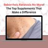 Seborrheic Keratosis No More