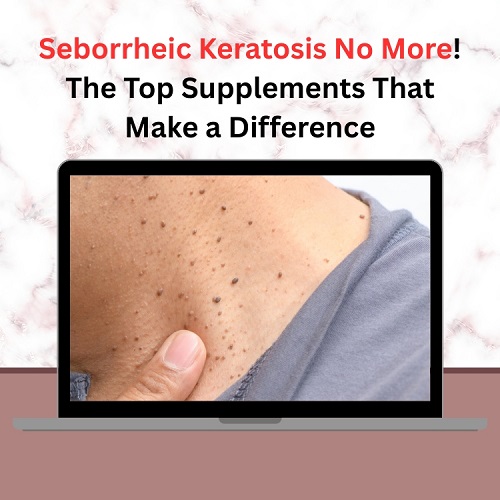 Seborrheic Keratosis No More